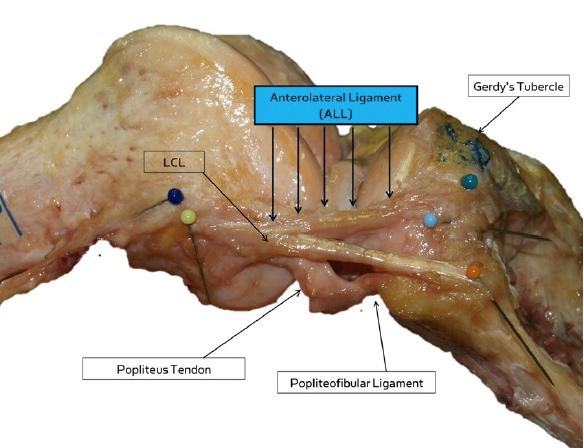 new ligament discovered in Human knee, new human part discovered, new ligament knee, new ligament human knee, new knee ligament, Anatomy of the anterolateral ligament of the knee, New Ligament Discovered‬ In the Human Knee, unknown ligament discovered, amazing medical discovery: new ligament in human knee, new human part discovered, strange medical discovery, astounishing medical discovery, The new discovered ligament (the anterolateral ligament or ALL) depicted on a right knee, University Hospitals Leuven ligament discovery