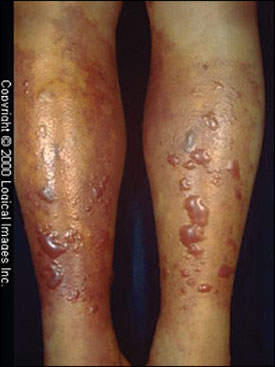 infection of flesh-eating bacteria vibrio vulnificus., disease caused by flesh-eating bacteria vibrio vulnificus., Example of tissue infections produced by the flesh-eating bacteria vibrio vulnificus., Vibrio vulnificus invasion florida 2014, flesh-eating bacteria plague and invasion florida 2014, flesh-eating bacteria florida july 2014, deadly bacteria florida, plague bacteria florida 2014, flesh-eating bacteria florida 20014, deadly plague of flesh-eating bacteria florida 2014, Vibrio vulnificus (flesh-eating bacteria) has now invaded Florida waters. Photo: Wikipedia Common