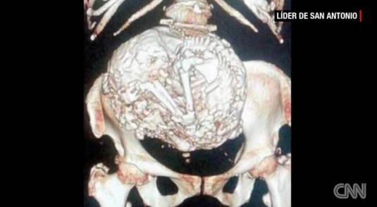 calcified foetus in old woman,calcified foetus Estela Melendez, calcified foetus in 91yo woman, 91-year-old woman told she's been carrying a foetus inside her for more than 60 years, calcified foetus, Estela Melendez story