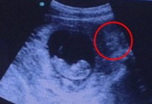 demon ultrasound, hindu goddess ultrasound, creepy demon face ultrasound, creepy face watch over foetus ultrasound image, creepy hindu goddess foetus ultrasound picture, Scan photo appears to show a creepy figure watching over the foetus