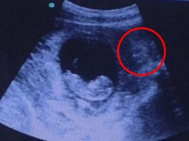 demon ultrasound, hindu goddess ultrasound, creepy demon face ultrasound, creepy face watch over foetus ultrasound image, creepy hindu goddess foetus ultrasound picture, Scan photo appears to show a creepy figure watching over the foetus