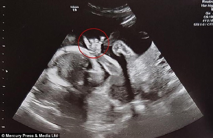 unborn baby devil horns, unborn baby devil horns picture, Scan shows unborn baby making heavy metal devil horns gesture