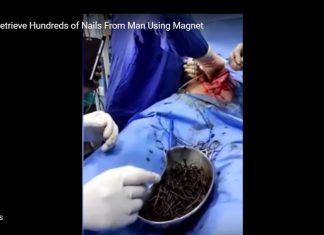 surgeons retrieve hundreds of nails from man video, Surgeons in Calcutta retrieved hundreds of nails from a schizophrenic man a filmed a video, surgeons retrieve hundreds of nails from man video pictures