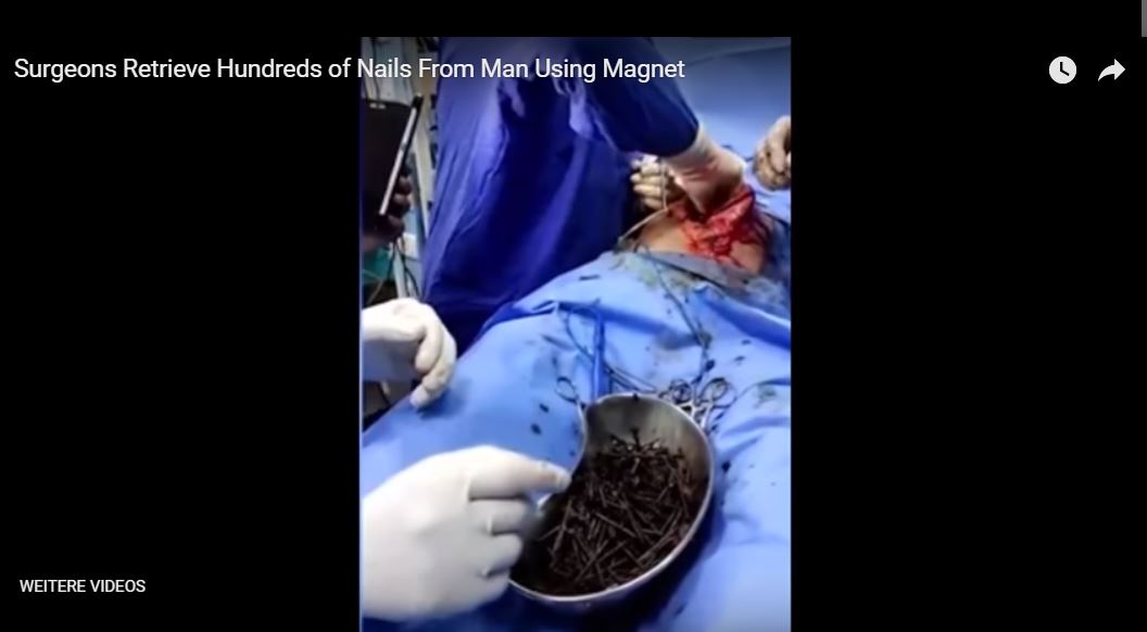 surgeons retrieve hundreds of nails from man video, Surgeons in Calcutta retrieved hundreds of nails from a schizophrenic man a filmed a video, surgeons retrieve hundreds of nails from man video pictures
