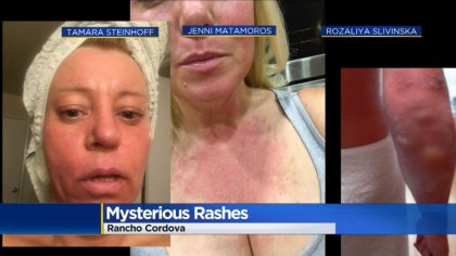 mysterious rashes california fires july 2018, mysterious rashes california fires july 2018 video, mysterious rashes california fires july 2018 pictures