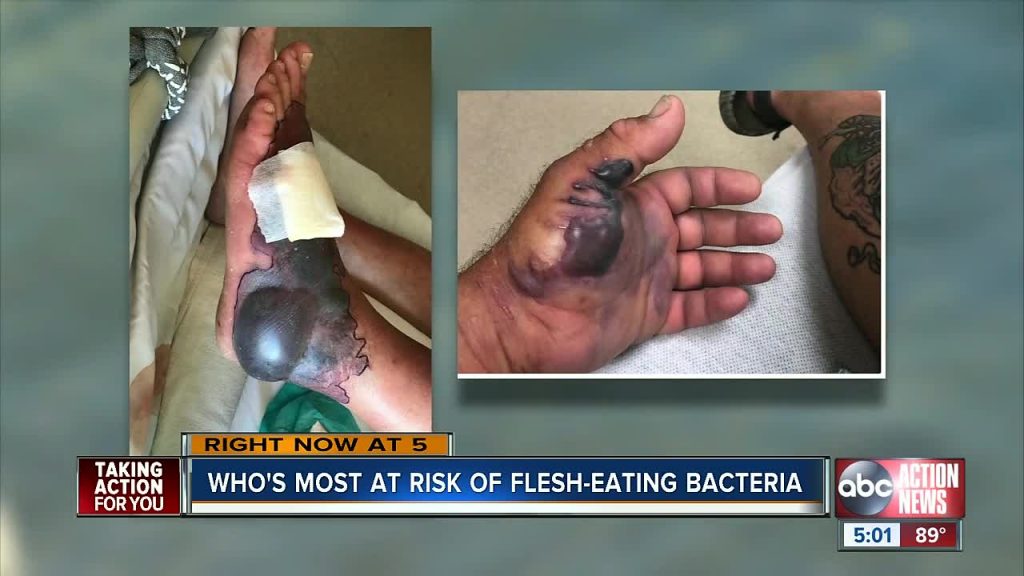 Who's most at risk of flesh-eating bacteria?