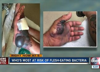 Who's most at risk of flesh-eating bacteria?