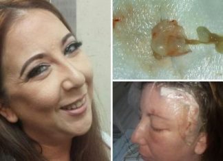 Video: It was a tapeworm, not a brain tumor, Woman's Brain Cancer Scare Turns Out to Be Tapeworm