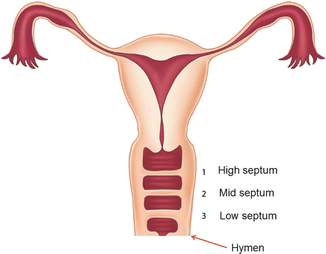 transverse vaginal septum