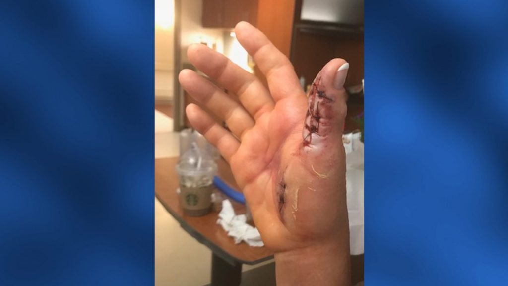 manicure flesh eating bacteria tennesse, manicure flesh eating bacteria tennesse pictures, manicure flesh eating bacteria tennesse video,Woman says she almost lost hand to flesh-eating bacteria after getting manicure at nail salon, 