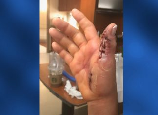 manicure flesh eating bacteria tennesse, manicure flesh eating bacteria tennesse pictures, manicure flesh eating bacteria tennesse video,Woman says she almost lost hand to flesh-eating bacteria after getting manicure at nail salon,