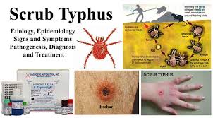 scrub typhus, scrub typhus epidemic starts in India, scrub typhus epidemic starts in India september 2019