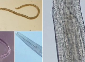 A Second Woman Has Gotten Parasitic Eye Worms, and Surely We're All Next, nebraska parasitic eye worm