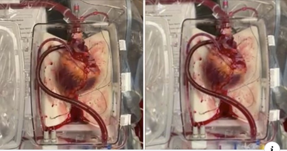 U.S. doctors bring dead heart back to life in groundbreaking surgery