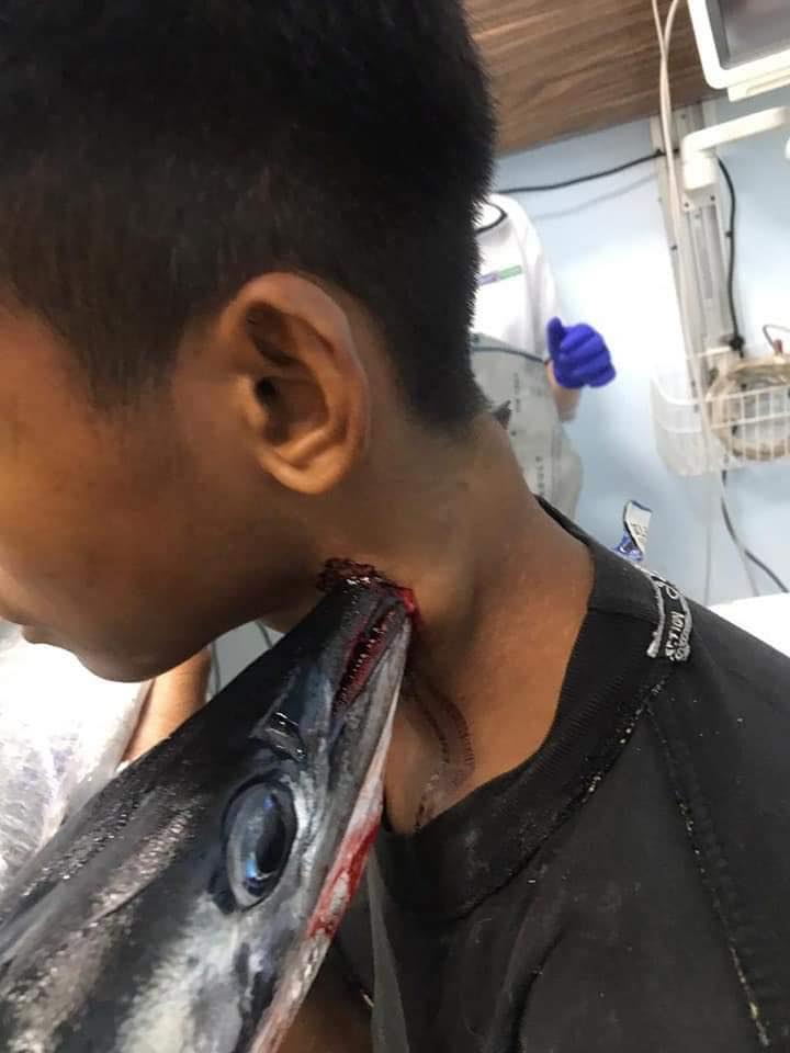 Needlefish in the neck of an indonesian teen, Needlefish in the neck of an indonesian teen pictures, Needlefish in the neck of an indonesian teen video
