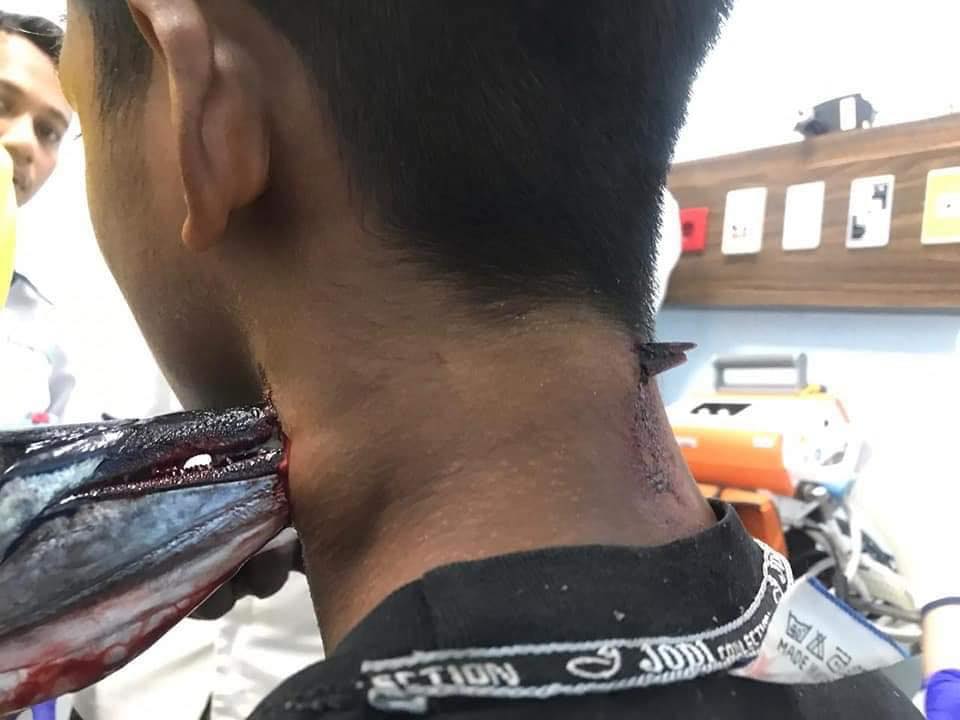 Needlefish in the neck of an indonesian teen, Needlefish in the neck of an indonesian teen pictures, Needlefish in the neck of an indonesian teen video