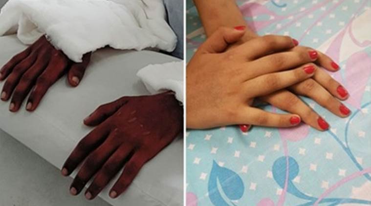 Transplanted Hands Change Color and Shape, Freeky hand transplatation in India, Freeky hand transplatation in India: Her transplanted hands changed in shape and color after the operation
