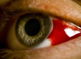 Disease X, bleeding eye fever, bleeding eye fever ethiopia, Disease X might be bleeding eye fever in Ethiopia
