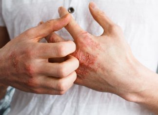 eczema cure, eczema remedy, best natural remedies for eczema