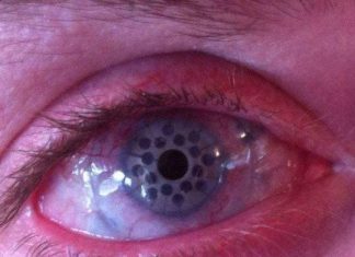 keratoprosthesis, how is it after a keratoprosthesis how does your eye looks like after a keratoprosthesis