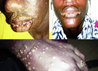 senegal mysterious disease fishermen, Mysterious disease hit more than 500 fishermen in Senegal