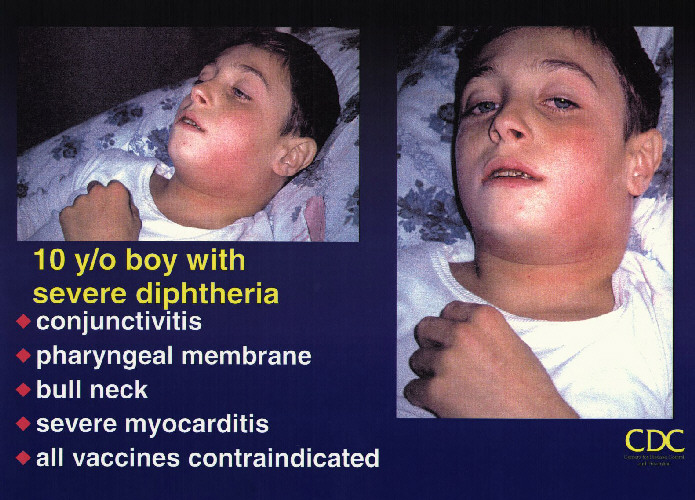 Diphtheria risks becoming major global threat again as it evolves antimicrobial resistance