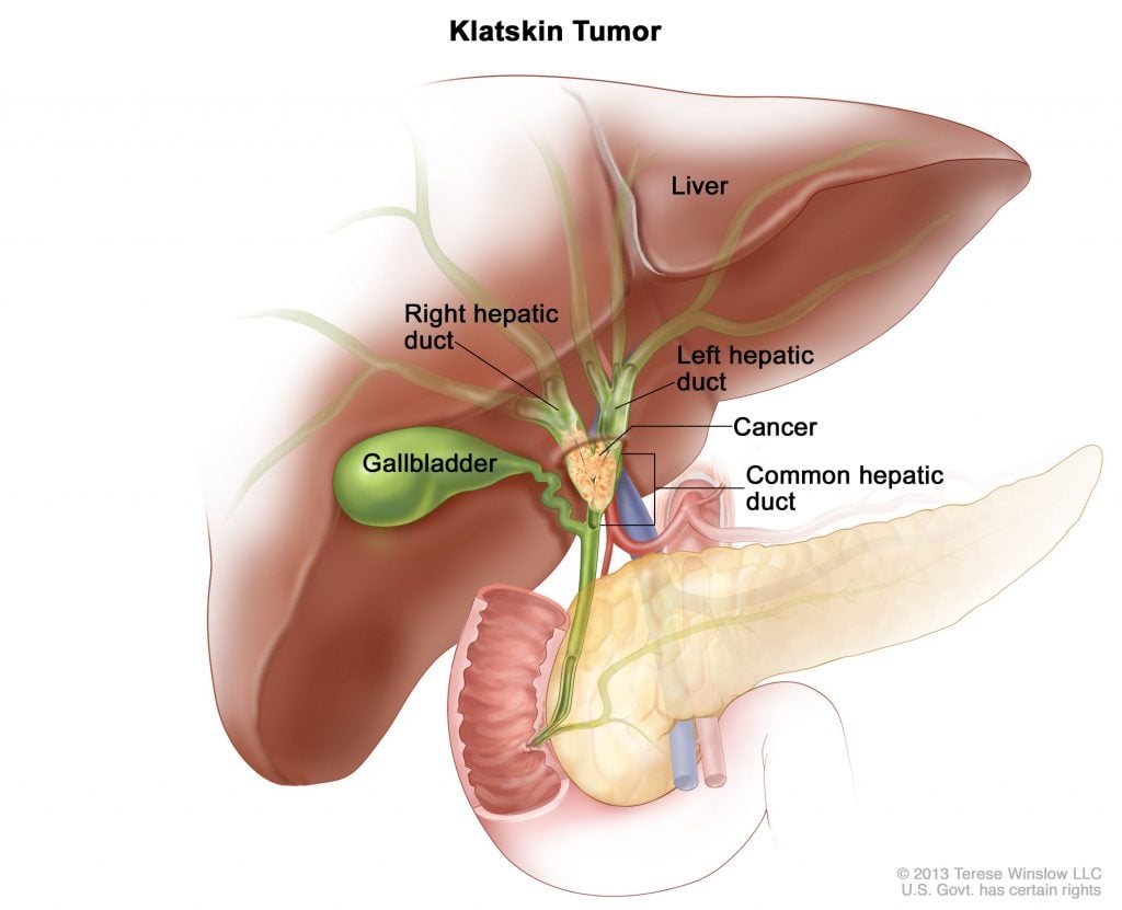 klatskin tumor, klatskin tumor treatment, how to cure klatskin tumor, klatskin tumor cure