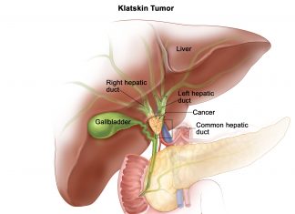 klatskin tumor, klatskin tumor treatment, how to cure klatskin tumor, klatskin tumor cure
