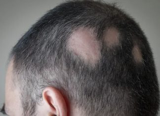 A first-of-its-kind alopecia treatment that triggers hair growth was just approved by the FDA