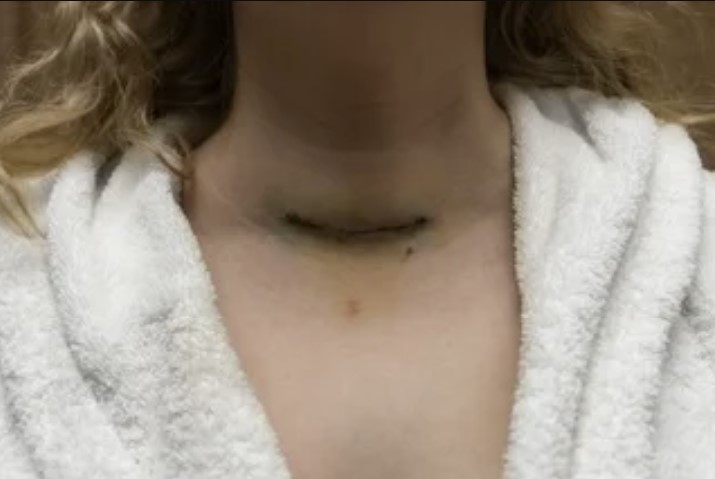 A Chernobyl necklace is a horizontal scar at the base of the throat which results from surgery to remove a thyroid cancer caused by fallout from a nuclear accident. The scar has come to be seen as one of the most graphic demonstrations of the impact of the Chernobyl disaster.