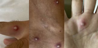Man infects himself with Covid Monkeypox and HIV